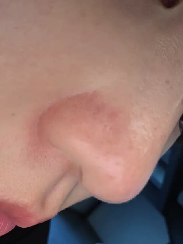 [毛孔潔淨]ilso黑頭粉刺導出液