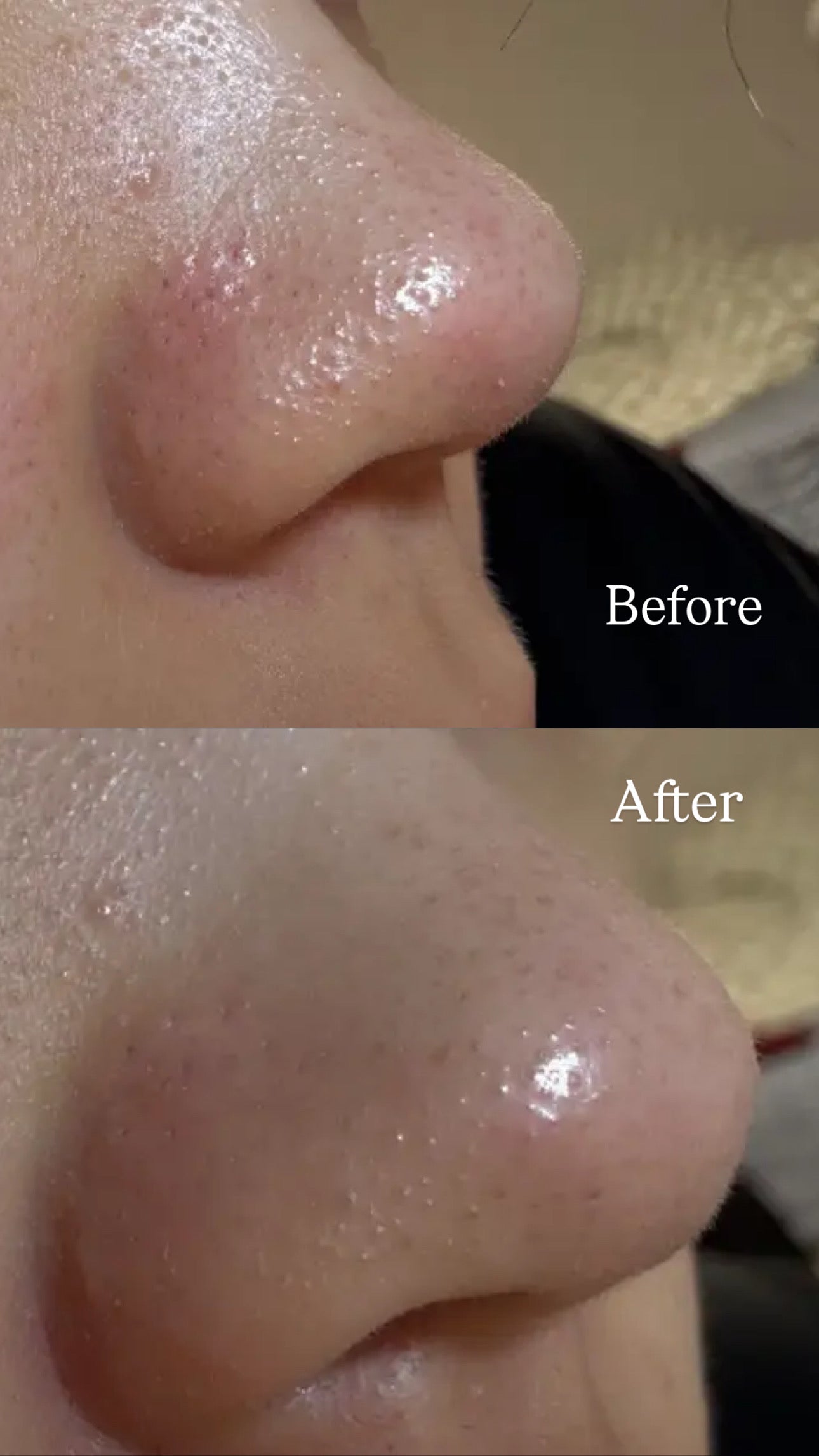 [毛孔潔淨]ilso黑頭粉刺導出液