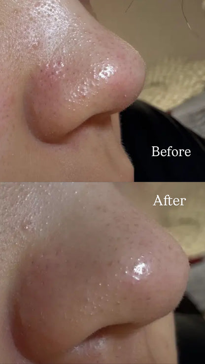 [毛孔潔淨]ilso黑頭粉刺導出液