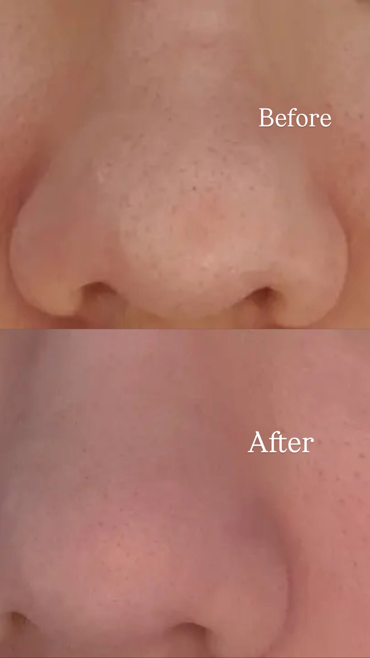 [毛孔潔淨]ilso黑頭粉刺導出液