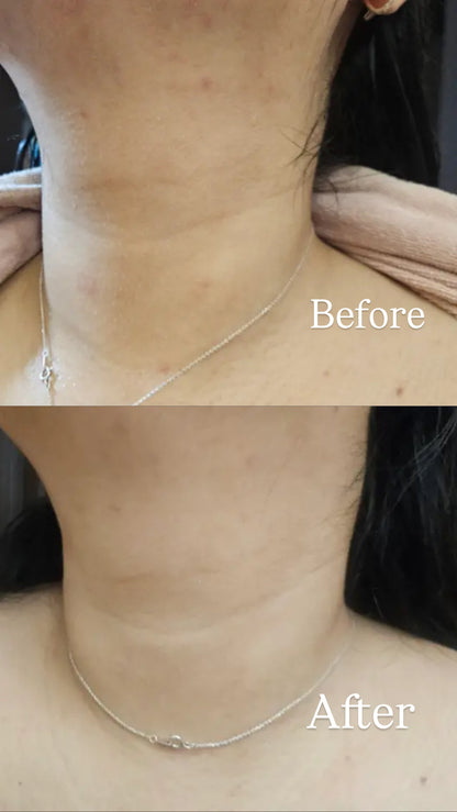 [背部暗瘡]Fation消背痘身體粗糙顆粒噴霧