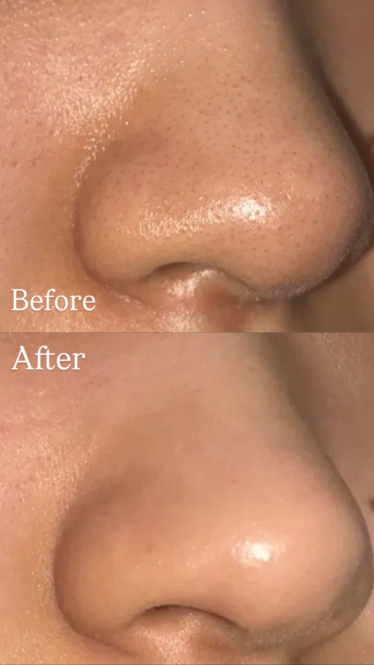 [毛孔潔淨]ilso黑頭粉刺導出液