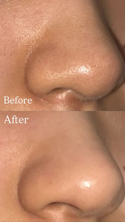 [毛孔潔淨]ilso黑頭粉刺導出液