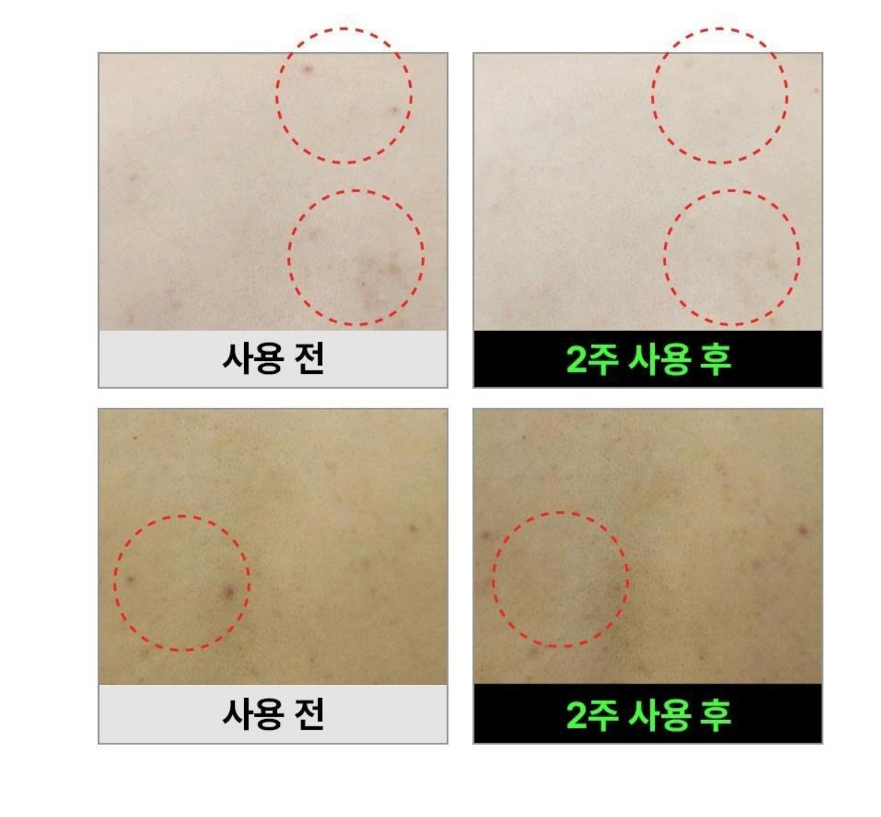 [背部暗瘡]Fation消背痘身體粗糙顆粒噴霧