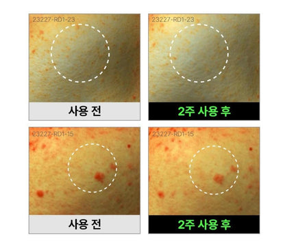 [背部暗瘡]Fation消背痘身體粗糙顆粒噴霧