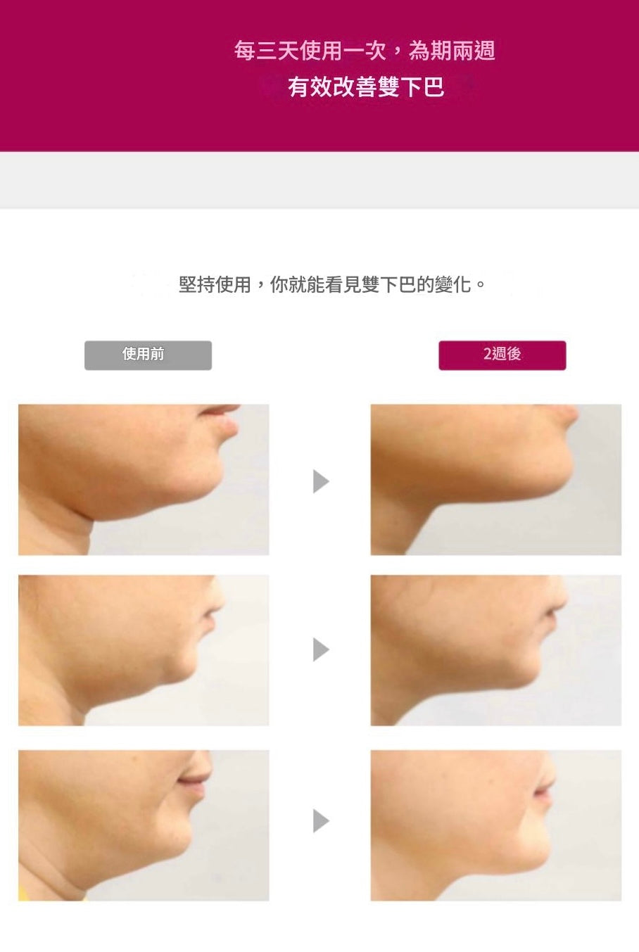 [V面消腫]ANACIS塑形瘦臉緊緻繃帶