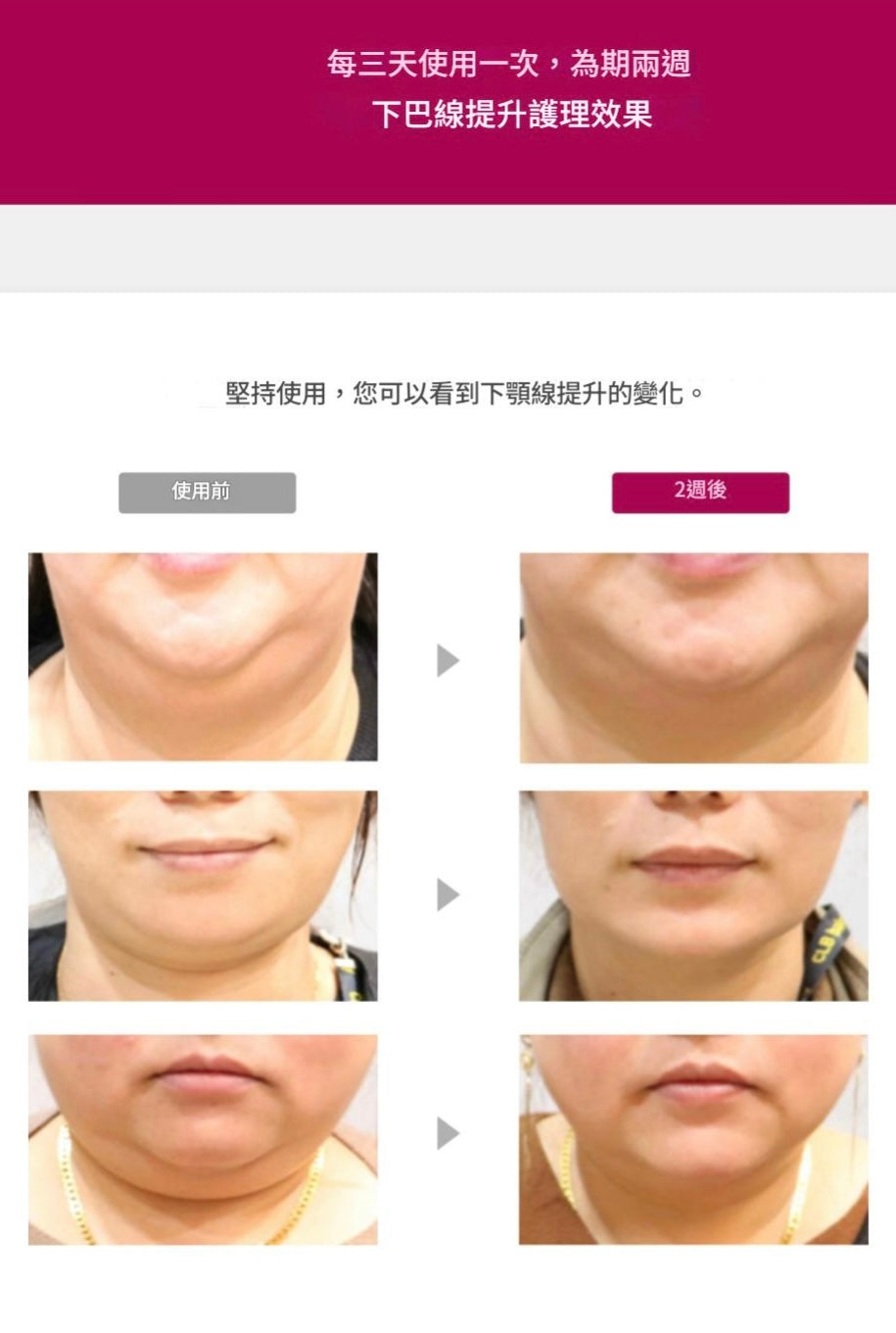 [V面消腫]ANACIS塑形瘦臉緊緻繃帶