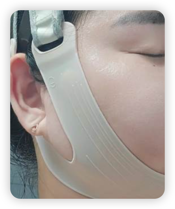 [V面消腫]ANACIS塑形瘦臉緊緻繃帶